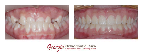 Orthodontic Underbite treatment, Georgia Orthodontic Care, Dr Nguyen, Orthodontic treatments, Orthodontists, Orthodontics, Cosmetic, 
Implant, Children, Family, Dentists, Clear, Braces, Invisible, Adults, Teens, Children, Clear Braces, Invisible Braces, Invisalign, 
Straighten, Teeth, Lawrenceville, Norcross, Buford, Hamilton Mill, Dacula, Auburn, Sugar Hill, Sugar Loaf, Doraville, Chamblee, Stone 
Mountain, Decatur, Collins Hill, Snellville, Suwanee, Grayson, Lilburn,...