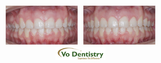 Gingivectomy, gum surgery, Gum laser, Georgia Orthodontic Care, Dr Nguyen, Orthodontic treatments, Orthodontists, Orthodontics, Cosmetic, 
Implant, Children, Family, Dentists, Clear, Braces, Invisible, Adults, Teens, Children, Clear Braces, Invisible Braces, Invisalign, 
Straighten, Teeth, Lawrenceville, Norcross, Buford, Hamilton Mill, Dacula, Auburn, Sugar Hill, Sugar Loaf, Doraville, Chamblee, Stone 
Mountain, Decatur, Collins Hill, Snellville, Suwanee, Grayson, Lil...