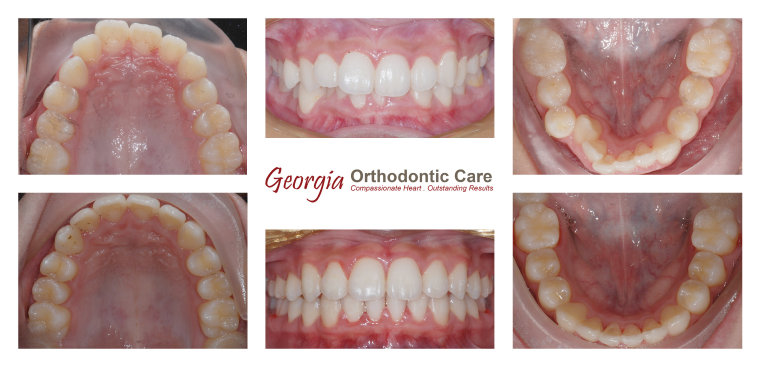 Dental crowding, non extraction orthodontic treatment, Georgia Orthodontic Care, Dr Nguyen, Orthodontic treatments, Orthodontists, 
Orthodontics, Cosmetic, Implant, Children, Family, Dentists, Clear, Braces, Invisible, Adults, Teens, Children, Clear Braces, Invisible 
Braces, Invisalign, Straighten, Teeth, Lawrenceville, Norcross, Buford, Hamilton Mill, Dacula, Auburn, Sugar Hill, Sugar Loaf, Doraville, 
Chamblee, Stone Mountain, Decatur, Collins Hill, Snellville, Suwa...