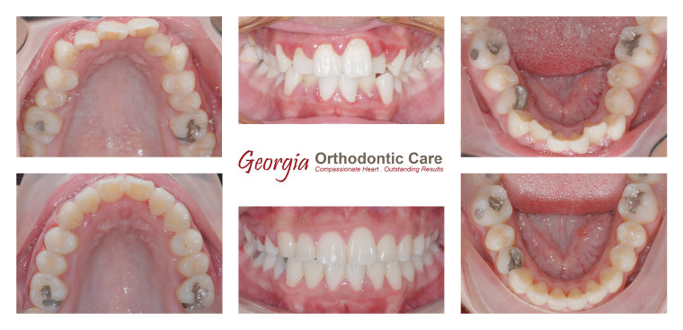 Dental crowding, non extraction orthodontic treatment, Georgia Orthodontic Care, Dr Nguyen, Orthodontic treatments, Orthodontists, 
Orthodontics, Cosmetic, Implant, Children, Family, Dentists, Clear, Braces, Invisible, Adults, Teens, Children, Clear Braces, Invisible 
Braces, Invisalign, Straighten, Teeth, Lawrenceville, Norcross, Buford, Hamilton Mill, Dacula, Auburn, Sugar Hill, Sugar Loaf, Doraville, 
Chamblee, Stone Mountain, Decatur, Collins Hill, Snellville, Suwa...