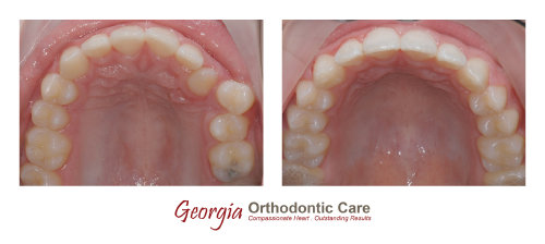 Dental crowding, non extraction orthodontic treatment, Georgia Orthodontic Care, Dr Nguyen, Orthodontic treatments, Orthodontists, 
Orthodontics, Cosmetic, Implant, Children, Family, Dentists, Clear, Braces, Invisible, Adults, Teens, Children, Clear Braces, Invisible 
Braces, Invisalign, Straighten, Teeth, Lawrenceville, Norcross, Buford, Hamilton Mill, Dacula, Auburn, Sugar Hill, Sugar Loaf, Doraville, 
Chamblee, Stone Mountain, Decatur, Collins Hill, Snellville, Suwa...