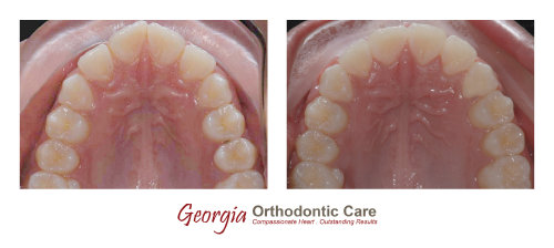 Dental crowding, non extraction orthodontic treatment, Georgia Orthodontic Care, Dr Nguyen, Orthodontic treatments, Orthodontists, 
Orthodontics, Cosmetic, Implant, Children, Family, Dentists, Clear, Braces, Invisible, Adults, Teens, Children, Clear Braces, Invisible 
Braces, Invisalign, Straighten, Teeth, Lawrenceville, Norcross, Buford, Hamilton Mill, Dacula, Auburn, Sugar Hill, Sugar Loaf, Doraville, 
Chamblee, Stone Mountain, Decatur, Collins Hill, Snellville, Suwa...
