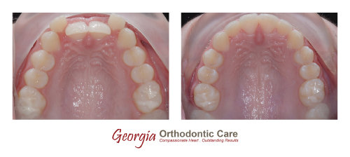 Dental crowding, non extraction orthodontic treatment, Georgia Orthodontic Care, Dr Nguyen, Orthodontic treatments, Orthodontists, 
Orthodontics, Cosmetic, Implant, Children, Family, Dentists, Clear, Braces, Invisible, Adults, Teens, Children, Clear Braces, Invisible 
Braces, Invisalign, Straighten, Teeth, Lawrenceville, Norcross, Buford, Hamilton Mill, Dacula, Auburn, Sugar Hill, Sugar Loaf, Doraville, 
Chamblee, Stone Mountain, Decatur, Collins Hill, Snellville, Suwa...