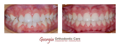 Dental crowding, non extraction orthodontic treatment, Georgia Orthodontic Care, Dr Nguyen, Orthodontic treatments, Orthodontists, 
Orthodontics, Cosmetic, Implant, Children, Family, Dentists, Clear, Braces, Invisible, Adults, Teens, Children, Clear Braces, Invisible 
Braces, Invisalign, Straighten, Teeth, Lawrenceville, Norcross, Buford, Hamilton Mill, Dacula, Auburn, Sugar Hill, Sugar Loaf, Doraville, 
Chamblee, Stone Mountain, Decatur, Collins Hill, Snellville, Suwa...