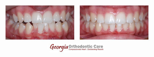 Dental crowding, non extraction orthodontic treatment, Georgia Orthodontic Care, Dr Nguyen, Orthodontic treatments, Orthodontists, 
Orthodontics, Cosmetic, Implant, Children, Family, Dentists, Clear, Braces, Invisible, Adults, Teens, Children, Clear Braces, Invisible 
Braces, Invisalign, Straighten, Teeth, Lawrenceville, Norcross, Buford, Hamilton Mill, Dacula, Auburn, Sugar Hill, Sugar Loaf, Doraville, 
Chamblee, Stone Mountain, Decatur, Collins Hill, Snellville, Suwa...
