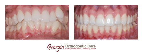Dental crowding, non extraction orthodontic treatment, Georgia Orthodontic Care, Dr Nguyen, Orthodontic treatments, Orthodontists, 
Orthodontics, Cosmetic, Implant, Children, Family, Dentists, Clear, Braces, Invisible, Adults, Teens, Children, Clear Braces, Invisible 
Braces, Invisalign, Straighten, Teeth, Lawrenceville, Norcross, Buford, Hamilton Mill, Dacula, Auburn, Sugar Hill, Sugar Loaf, Doraville, 
Chamblee, Stone Mountain, Decatur, Collins Hill, Snellville, Suwa...