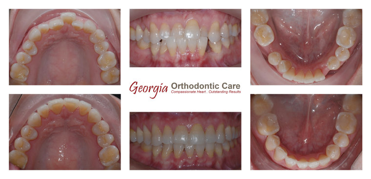 Taking Care Of Braces  Webb & Goldsmith Orthodontics