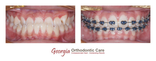 Orthodontic Underbite treatment, Georgia Orthodontic Care, Dr Nguyen, Orthodontic treatments, Orthodontists, Orthodontics, Cosmetic, 
Implant, Children, Family, Dentists, Clear, Braces, Invisible, Adults, Teens, Children, Clear Braces, Invisible Braces, Invisalign, 
Straighten, Teeth, Lawrenceville, Norcross, Buford, Hamilton Mill, Dacula, Auburn, Sugar Hill, Sugar Loaf, Doraville, Chamblee, Stone 
Mountain, Decatur, Collins Hill, Snellville, Suwanee, Grayson, Lilburn,...