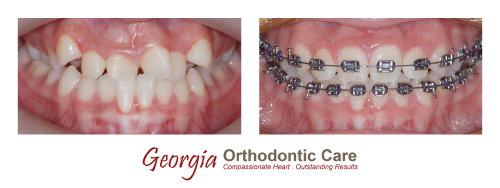 Orthodontic crossbite treatment, cross bite treatment, Georgia Orthodontic Care, Dr Nguyen, Orthodontic treatments, Orthodontists, 
Orthodontics, Cosmetic, Implant, Children, Family, Dentists, Clear, Braces, Invisible, Adults, Teens, Children, Clear Braces, Invisible 
Braces, Invisalign, Straighten, Teeth, Lawrenceville, Norcross, Buford, Hamilton Mill, Dacula, Auburn, Sugar Hill, Sugar Loaf, Doraville, 
Chamblee, Stone Mountain, Decatur, Collins Hill, Snellville, Suwa...