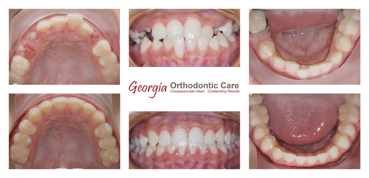 Orthodontic crossbite treatment, cross bite treatment, Georgia Orthodontic Care, Dr Nguyen, Orthodontic treatments, Orthodontists, 
Orthodontics, Cosmetic, Implant, Children, Family, Dentists, Clear, Braces, Invisible, Adults, Teens, Children, Clear Braces, Invisible 
Braces, Invisalign, Straighten, Teeth, Lawrenceville, Norcross, Buford, Hamilton Mill, Dacula, Auburn, Sugar Hill, Sugar Loaf, Doraville, 
Chamblee, Stone Mountain, Decatur, Collins Hill, Snellville, Suwa...