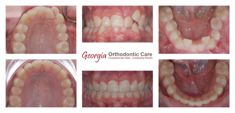 Orthodontic crossbite treatment, cross bite treatment, Georgia Orthodontic Care, Dr Nguyen, Orthodontic treatments, Orthodontists, 
Orthodontics, Cosmetic, Implant, Children, Family, Dentists, Clear, Braces, Invisible, Adults, Teens, Children, Clear Braces, Invisible 
Braces, Invisalign, Straighten, Teeth, Lawrenceville, Norcross, Buford, Hamilton Mill, Dacula, Auburn, Sugar Hill, Sugar Loaf, Doraville, 
Chamblee, Stone Mountain, Decatur, Collins Hill, Snellville, Suwa...