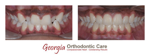 Orthodontic crossbite treatment, cross bite treatment, Georgia Orthodontic Care, Dr Nguyen, Orthodontic treatments, Orthodontists, 
Orthodontics, Cosmetic, Implant, Children, Family, Dentists, Clear, Braces, Invisible, Adults, Teens, Children, Clear Braces, Invisible 
Braces, Invisalign, Straighten, Teeth, Lawrenceville, Norcross, Buford, Hamilton Mill, Dacula, Auburn, Sugar Hill, Sugar Loaf, Doraville, 
Chamblee, Stone Mountain, Decatur, Collins Hill, Snellville, Suwa...