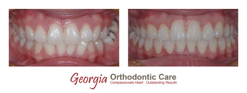 Orthodontic crossbite treatment, cross bite treatment, Georgia Orthodontic Care, Dr Nguyen, Orthodontic treatments, Orthodontists, 
Orthodontics, Cosmetic, Implant, Children, Family, Dentists, Clear, Braces, Invisible, Adults, Teens, Children, Clear Braces, Invisible 
Braces, Invisalign, Straighten, Teeth, Lawrenceville, Norcross, Buford, Hamilton Mill, Dacula, Auburn, Sugar Hill, Sugar Loaf, Doraville, 
Chamblee, Stone Mountain, Decatur, Collins Hill, Snellville, Suwa...