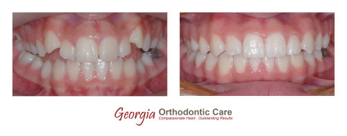 Orthodontic crossbite treatment, cross bite treatment, Georgia Orthodontic Care, Dr Nguyen, Orthodontic treatments, Orthodontists, 
Orthodontics, Cosmetic, Implant, Children, Family, Dentists, Clear, Braces, Invisible, Adults, Teens, Children, Clear Braces, Invisible 
Braces, Invisalign, Straighten, Teeth, Lawrenceville, Norcross, Buford, Hamilton Mill, Dacula, Auburn, Sugar Hill, Sugar Loaf, Doraville, 
Chamblee, Stone Mountain, Decatur, Collins Hill, Snellville, Suwa...