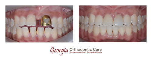 Orthodontic space consolidation, space closure, gap closure, diastema closure, cross bite treatment, Georgia Orthodontic Care, Dr 
Nguyen, Orthodontic treatments, Orthodontists, Orthodontics, Cosmetic, Implant, Children, Family, Dentists, Clear, Braces, Invisible, 
Adults, Teens, Children, Clear Braces, Invisible Braces, Invisalign, Straighten, Teeth, Lawrenceville, Norcross, Buford, Hamilton 
Mill, Dacula, Auburn, Sugar Hill, Sugar Loaf, Doraville, Chamblee, Stone Mou...