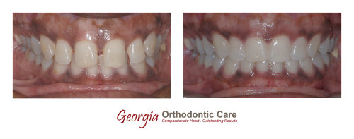 Orthodontic space consolidation, space closure, gap closure, diastema closure, cross bite treatment, Georgia Orthodontic Care, Dr 
Nguyen, Orthodontic treatments, Orthodontists, Orthodontics, Cosmetic, Implant, Children, Family, Dentists, Clear, Braces, Invisible, 
Adults, Teens, Children, Clear Braces, Invisible Braces, Invisalign, Straighten, Teeth, Lawrenceville, Norcross, Buford, Hamilton 
Mill, Dacula, Auburn, Sugar Hill, Sugar Loaf, Doraville, Chamblee, Stone Mou...