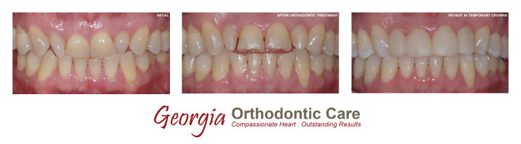 Orthodontic intrusion, restorative dentist, Georgia Orthodontic Care, Dr Nguyen, Orthodontic treatments, Orthodontists, Orthodontics, 
Cosmetic, Implant, Children, Family, Dentists, Clear, Braces, Invisible, Adults, Teens, Children, Clear Braces, Invisible Braces, 
Invisalign, Straighten, Teeth, Lawrenceville, Norcross, Buford, Hamilton Mill, Dacula, Auburn, Sugar Hill, Sugar Loaf, Doraville, 
Chamblee, Stone Mountain, Decatur, Collins Hill, Snellville, Suwanee, Grayso...