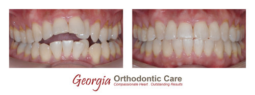 Orthodontic open bite treatments, Georgia Orthodontic Care, Dr Nguyen, Orthodontic treatments, Orthodontists, Orthodontics, Cosmetic, 
Implant, Children, Family, Dentists, Clear, Braces, Invisible, Adults, Teens, Children, Clear Braces, Invisible Braces, Invisalign, 
Straighten, Teeth, Lawrenceville, Norcross, Buford, Hamilton Mill, Dacula, Auburn, Sugar Hill, Sugar Loaf, Doraville, Chamblee, Stone 
Mountain, Decatur, Collins Hill, Snellville, Suwanee, Grayson, Lilburn...