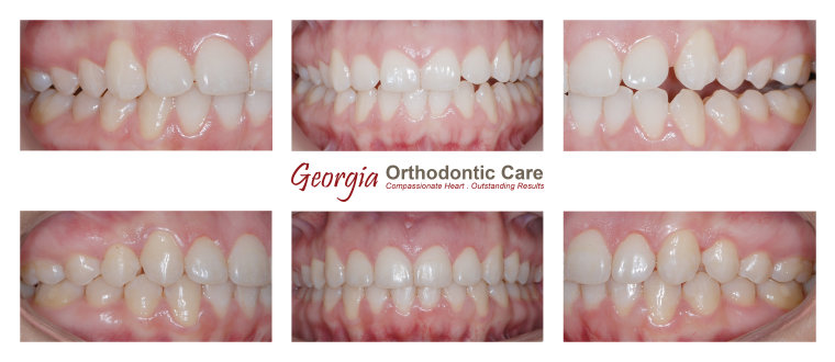 Orthodontic open bite treatments, Georgia Orthodontic Care, Dr Nguyen, Orthodontic treatments, Orthodontists, Orthodontics, Cosmetic, 
Implant, Children, Family, Dentists, Clear, Braces, Invisible, Adults, Teens, Children, Clear Braces, Invisible Braces, Invisalign, 
Straighten, Teeth, Lawrenceville, Norcross, Buford, Hamilton Mill, Dacula, Auburn, Sugar Hill, Sugar Loaf, Doraville, Chamblee, Stone 
Mountain, Decatur, Collins Hill, Snellville, Suwanee, Grayson, Lilburn...