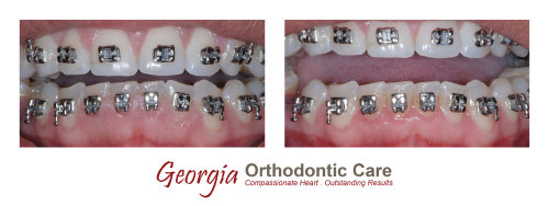 Gingivectomy, gum surgery, Gum laser, Georgia Orthodontic Care, Dr Nguyen, Orthodontic treatments, Orthodontists, Orthodontics, Cosmetic, 
Implant, Children, Family, Dentists, Clear, Braces, Invisible, Adults, Teens, Children, Clear Braces, Invisible Braces, Invisalign, 
Straighten, Teeth, Lawrenceville, Norcross, Buford, Hamilton Mill, Dacula, Auburn, Sugar Hill, Sugar Loaf, Doraville, Chamblee, Stone 
Mountain, Decatur, Collins Hill, Snellville, Suwanee, Grayson, Lil...