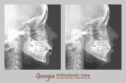 Class II division 1 treatments, teeth extraction, Georgia Orthodontic Care, Dr Nguyen, Orthodontic treatments, Orthodontists, Orthodontics, 
Cosmetic, Implant, Children, Family, Dentists, Clear, Braces, Invisible, Adults, Teens, Children, Clear Braces, Invisible Braces, 
Invisalign, Straighten, Teeth, Lawrenceville, Norcross, Buford, Hamilton Mill, Dacula, Auburn, Sugar Hill, Sugar Loaf, Doraville, 
Chamblee, Stone Mountain, Decatur, Collins Hill, Snellville, Suwanee, ...
